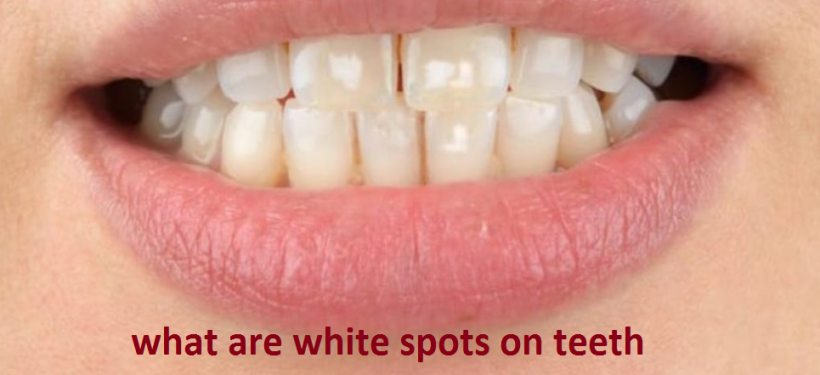 Why do i have white spots on my teeth